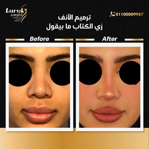 متى يظهر الشكل النهائي للأنف بعد عملية التجميل؟